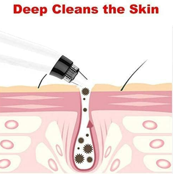 Derma Suction Pore and Blackheads Cleaner Device